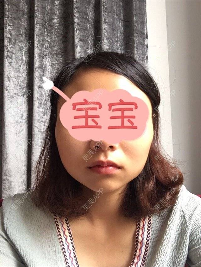 更美 - 家住山脚的姜小姐的除皱瘦脸经验 | 美购日记 | 除皱瘦脸 | 金华