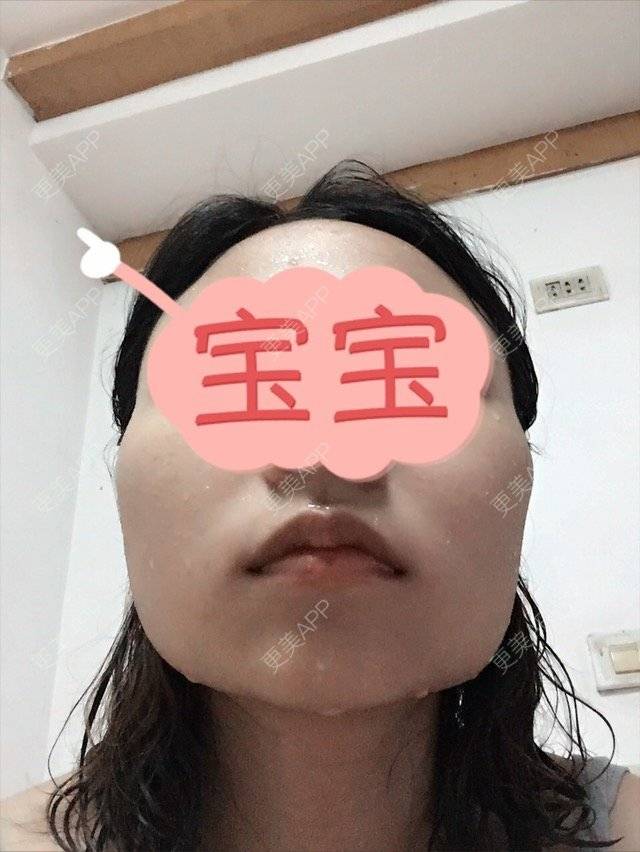 更美 - 家住山脚的姜小姐的除皱瘦脸经验 | 美购日记 | 除皱瘦脸 | 金华