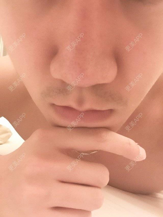 更美 - 更美用户OsABe7zfUU的经验 | 缩鼻翼 | 武汉