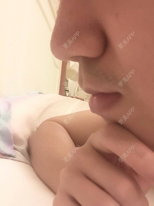 更美 - 更美用户OsABe7zfUU的经验 | 缩鼻翼 | 武汉