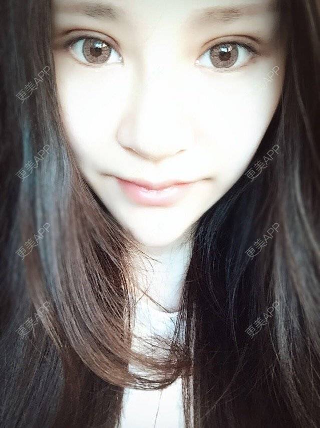 更美 - 神一样的雯雯的鼻部多项经验 | 上海 | 鼻部整形 | 隆鼻修复