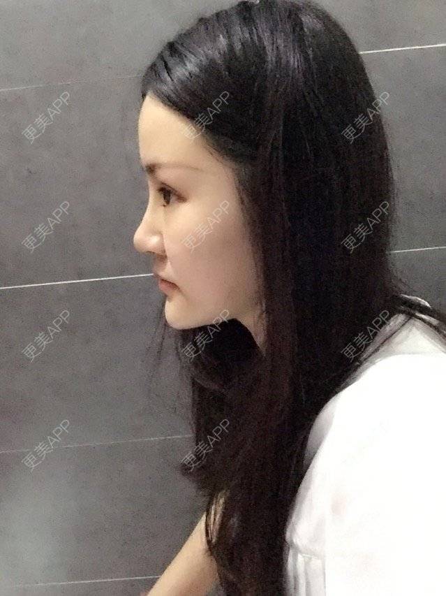 更美 - 神一样的雯雯的鼻部多项经验 | 上海 | 鼻部整形 | 隆鼻修复