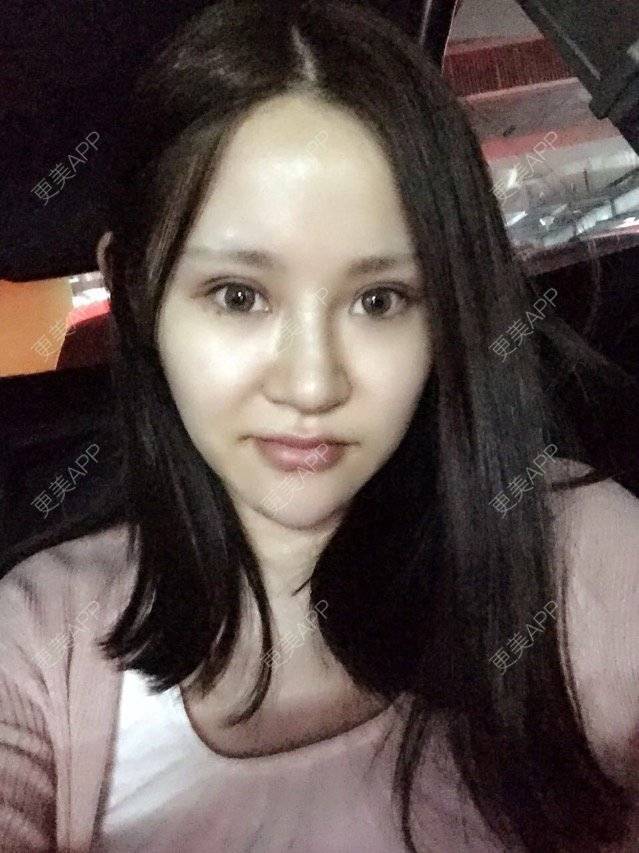 更美 - 神一样的雯雯的鼻部多项经验 | 上海 | 鼻部整形 | 隆鼻修复