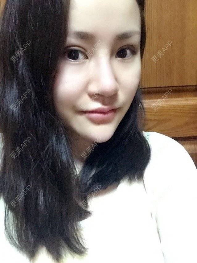 更美 - 神一样的雯雯的鼻部多项经验 | 上海 | 鼻部整形 | 隆鼻修复