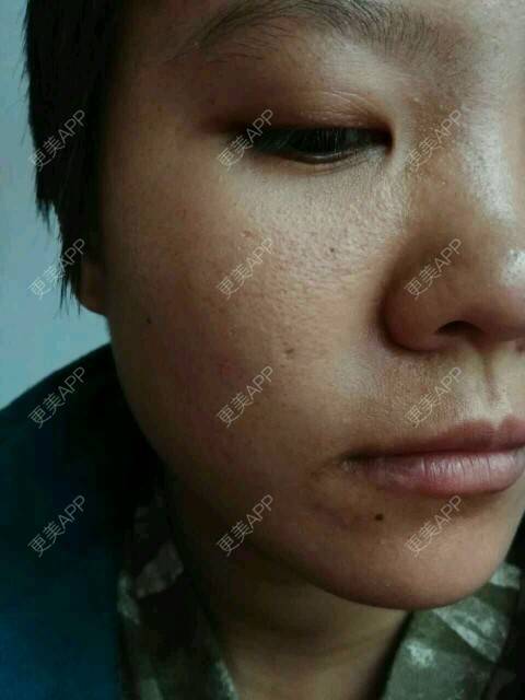 更美 - 更美用户mjSrECyvi3的经验 | 皮肤美容 | 注射美容 | 点阵激光 | 唐山