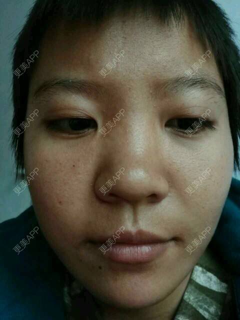 更美 - 更美用户mjSrECyvi3的经验 | 皮肤美容 | 注射美容 | 点阵激光 | 唐山