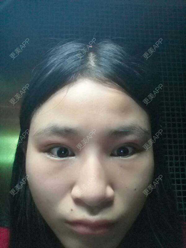 更美 - 小白这个的经验 | 开眼角 | 眼部修复 | 开外眼角 | 重庆