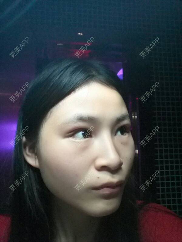 更美 - 小白这个的经验 | 开眼角 | 眼部修复 | 开外眼角 | 重庆