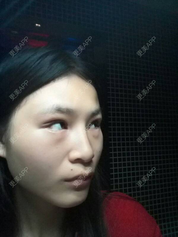 更美 - 小白这个的经验 | 开眼角 | 眼部修复 | 开外眼角 | 重庆