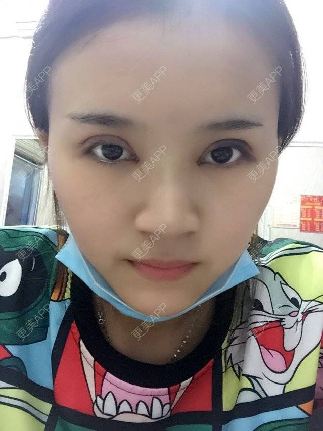 更美 - 更美用户MPsxvuz13R的全切双眼皮经验 | 开内眼角 | 进口玻尿酸填充鼻子 | 全切双眼皮 | 全切双眼皮去皮去脂肪 | 成都
