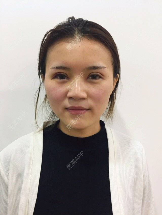 更美 - 更美用户MPsxvuz13R的全切双眼皮经验 | 开内眼角 | 进口玻尿酸填充鼻子 | 全切双眼皮 | 全切双眼皮去皮去脂肪 | 成都