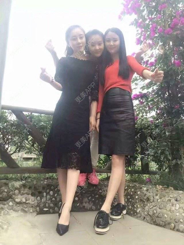 更美 - 何mm的经验 | 成都 | 综合隆鼻 | 所长精选 | 开内眼角 | 全切双眼皮去皮去脂肪