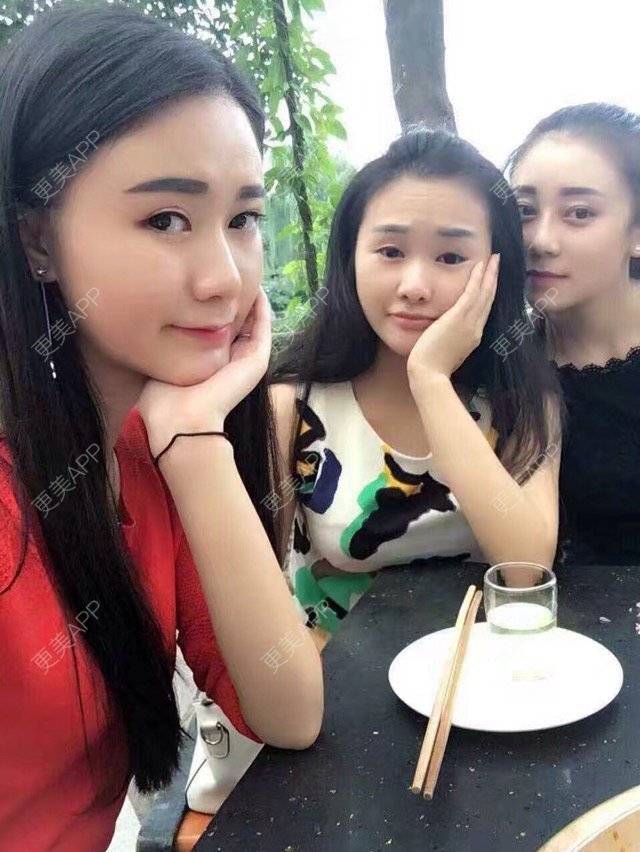 更美 - 何mm的经验 | 成都 | 综合隆鼻 | 所长精选 | 开内眼角 | 全切双眼皮去皮去脂肪