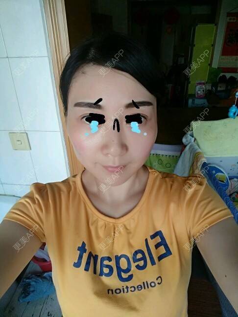 更美 - 天使伊婷的激光淡化红血丝经验 | 美购日记 | 激光淡化红血丝 | 微针放血治疗红血丝 | 西安