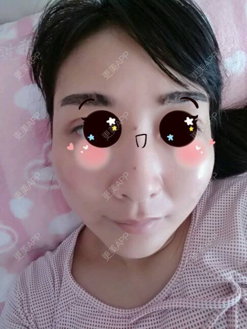 更美 - 天使伊婷的激光淡化红血丝经验 | 美购日记 | 激光淡化红血丝 | 微针放血治疗红血丝 | 西安