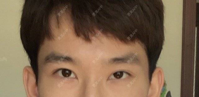 更美 - 李匿名的经验 | 修复双眼皮 | 大连