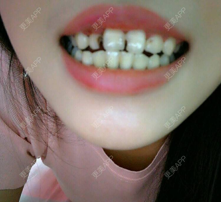 更美 - Mla的经验 | 补牙 | 深圳