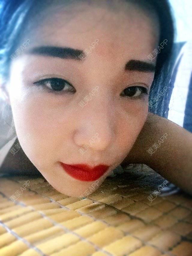 更美 - 梅萱的经验 | 内切去眼袋 | 广州