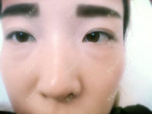 更美 - 梅萱的经验 | 内切去眼袋 | 广州