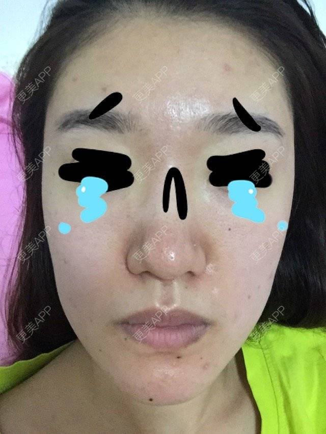 更美 - 楿里奈的果酸焕肤经验 | 美购日记 | 果酸焕肤 | 北京