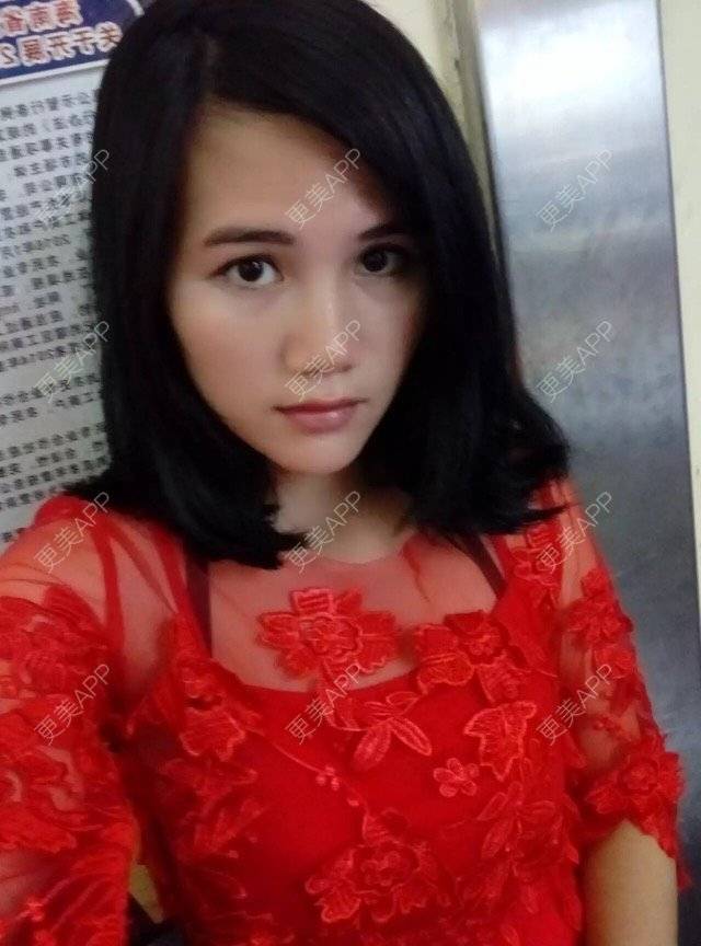 更美 - 彩虹桥东大门的经验 | 膨体隆鼻 | 鼻部整形 | 三亚