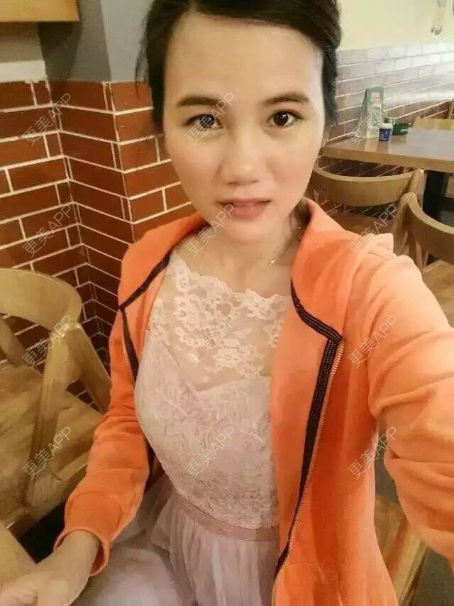 更美 - 彩虹桥东大门的经验 | 膨体隆鼻 | 鼻部整形 | 三亚