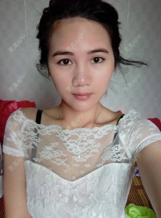 更美 - 彩虹桥东大门的经验 | 膨体隆鼻 | 鼻部整形 | 三亚