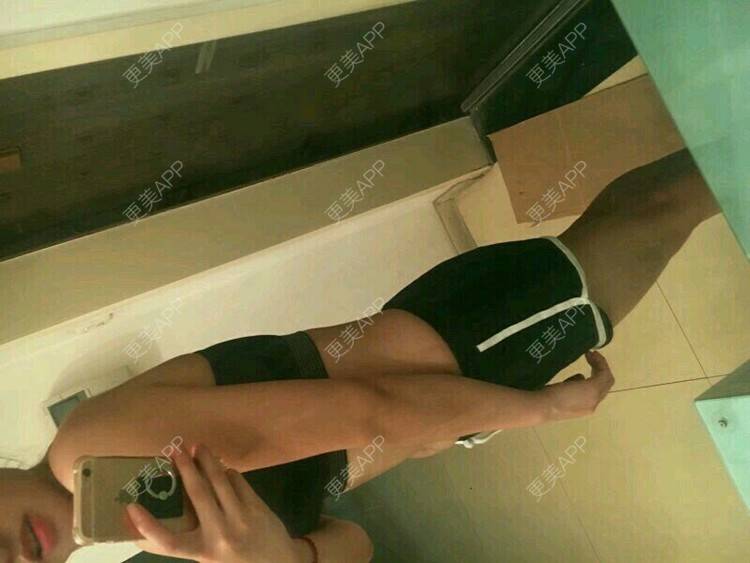 更美 - ♐✈ ☀ ❤ ✉ ♦☎✌㊗✂的腰腹吸脂经验 | 腰腹吸脂 | 重庆
