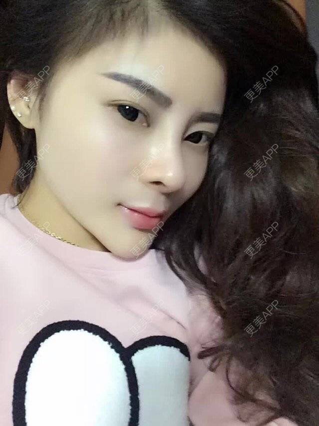 更美 - 华丹丹的经验 | 上海 | 假体隆鼻修复术