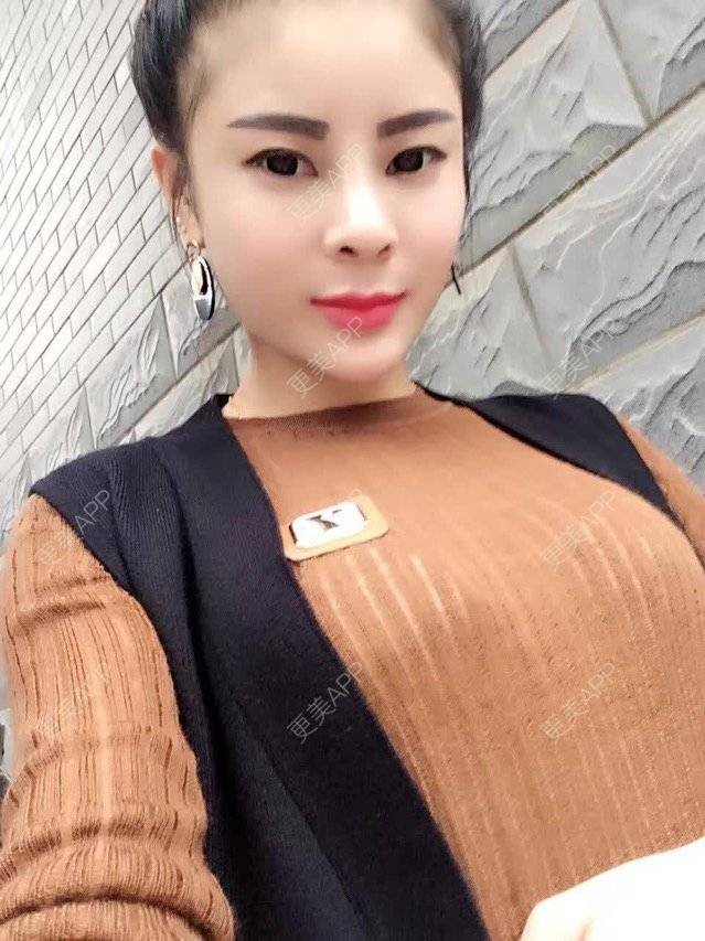 更美 - 华丹丹的经验 | 上海 | 假体隆鼻修复术
