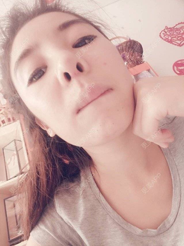 更美 - 大大的太阳好孩子的经验 | 上海 | 假体隆鼻修复术 | 术后求抱抱