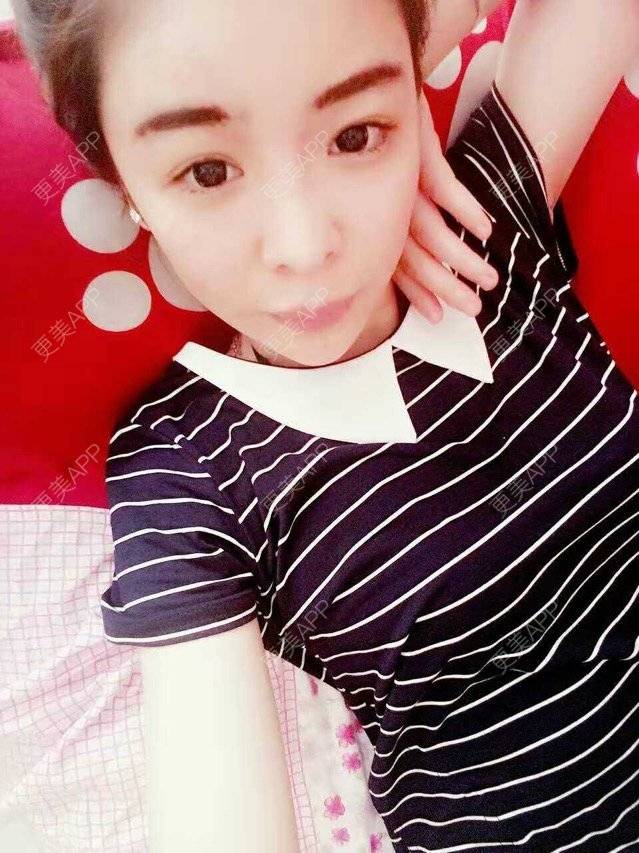 更美 - 大大的太阳好孩子的经验 | 上海 | 假体隆鼻修复术 | 术后求抱抱