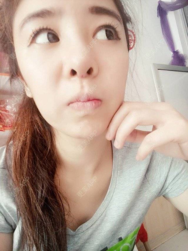 更美 - 大大的太阳好孩子的经验 | 上海 | 假体隆鼻修复术 | 术后求抱抱