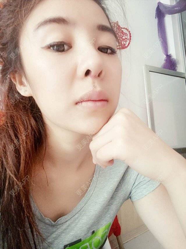 更美 - 大大的太阳好孩子的经验 | 上海 | 假体隆鼻修复术 | 术后求抱抱