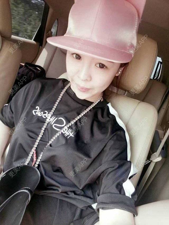 更美 - 大大的太阳好孩子的经验 | 上海 | 假体隆鼻修复术 | 术后求抱抱