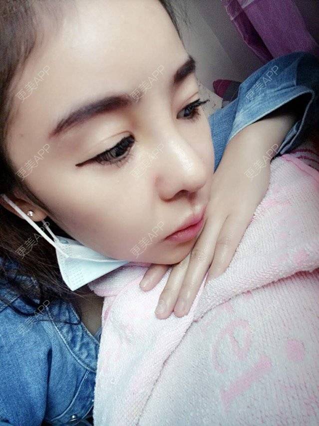 更美 - 大大的太阳好孩子的经验 | 上海 | 假体隆鼻修复术 | 鼻部修复
