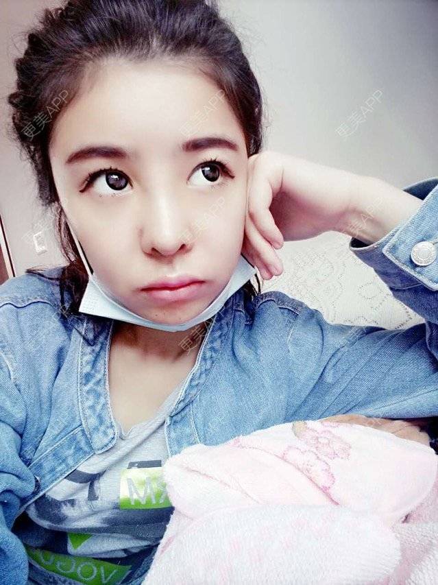 更美 - 大大的太阳好孩子的经验 | 上海 | 假体隆鼻修复术 | 鼻部修复