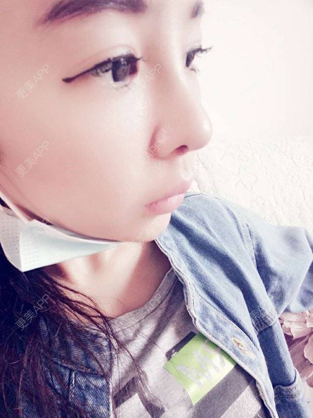 更美 - 大大的太阳好孩子的经验 | 上海 | 假体隆鼻修复术 | 鼻部修复