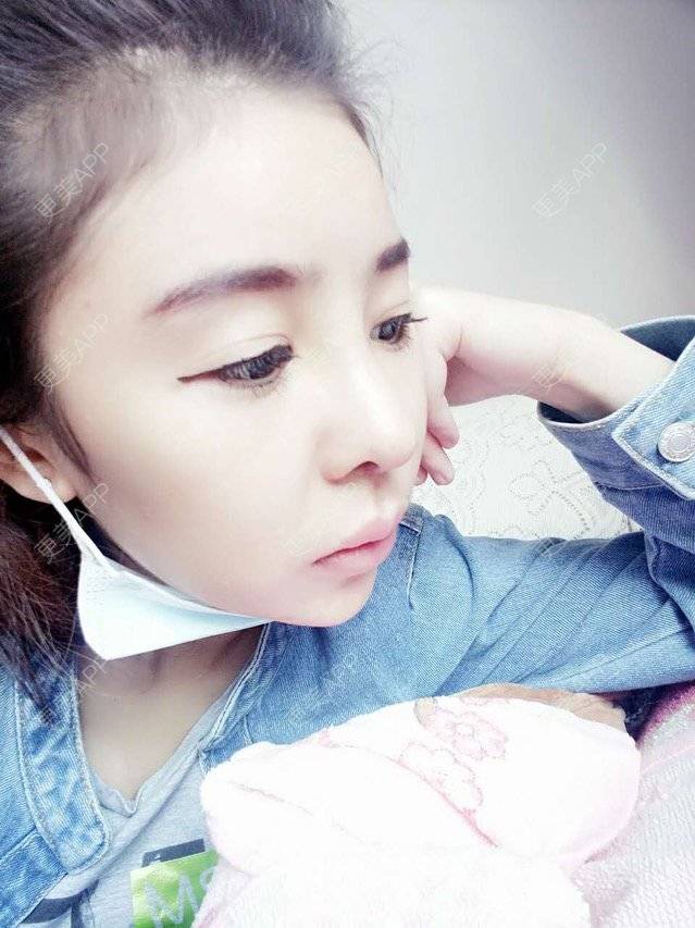 更美 - 大大的太阳好孩子的经验 | 上海 | 假体隆鼻修复术 | 鼻部修复