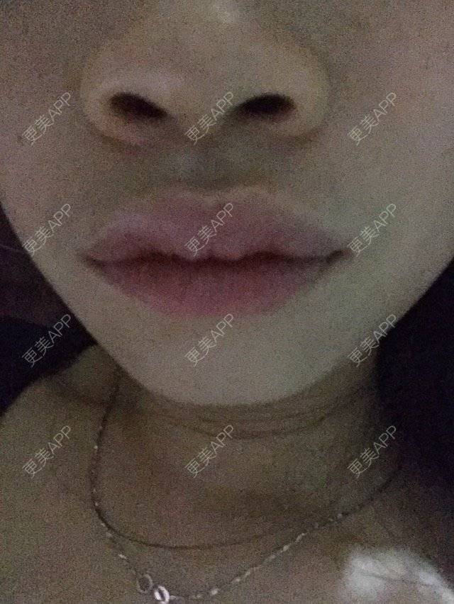 更美 - 更美用户4EBnad1nra的经验 | 厚唇改薄 | 深圳