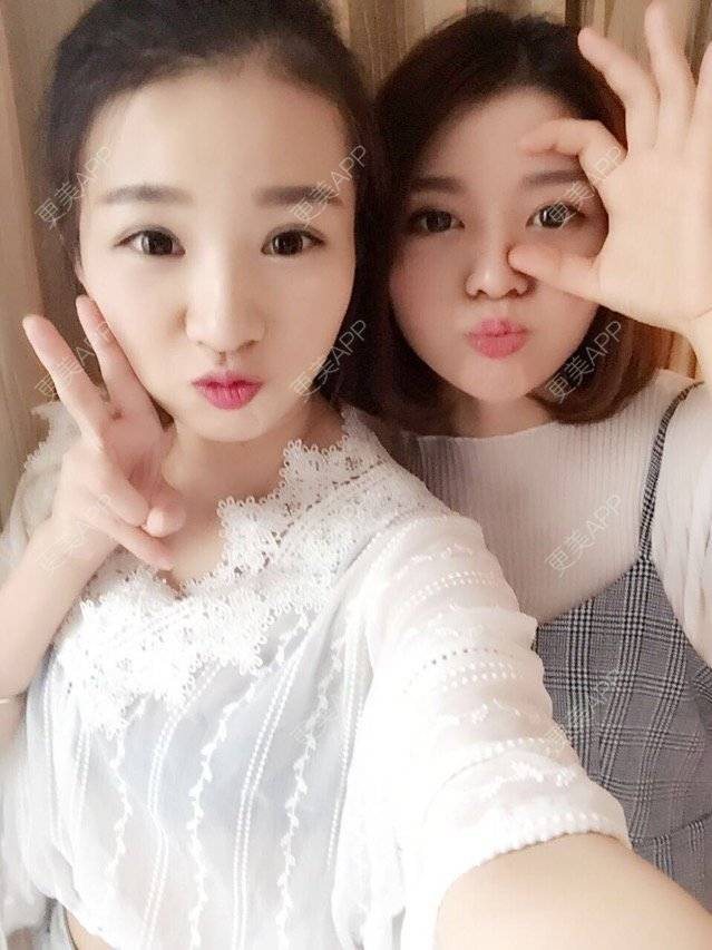 更美 - 唯艺妮子的玻尿酸下巴经验 | 上海 | 玻尿酸下巴