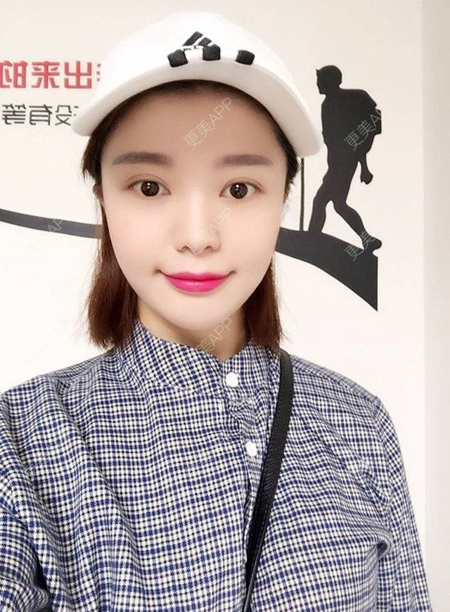 更美 - 唯艺妮子的玻尿酸下巴经验 | 上海 | 玻尿酸下巴