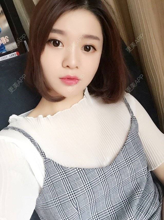 更美 - 唯艺妮子的玻尿酸下巴经验 | 上海 | 玻尿酸下巴