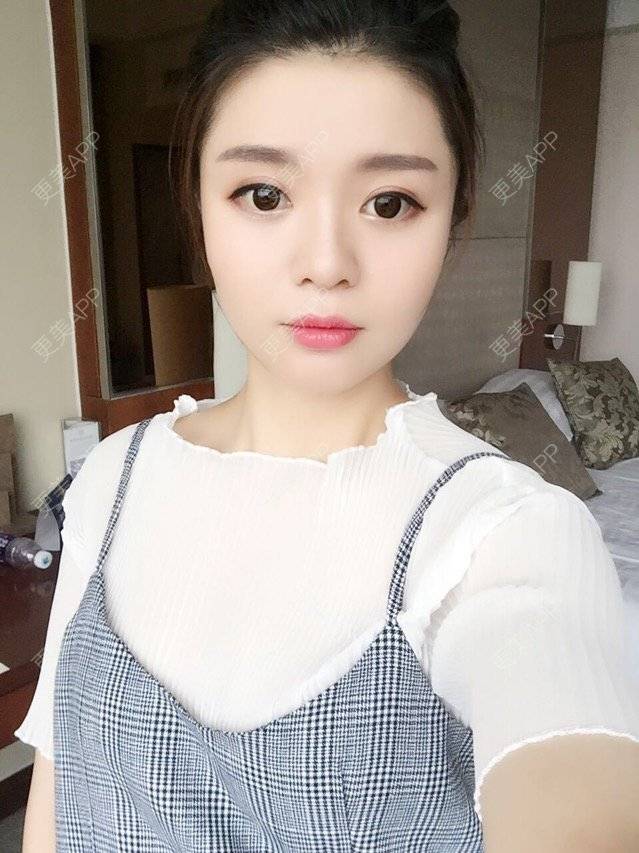 更美 - 唯艺妮子的玻尿酸下巴经验 | 上海 | 玻尿酸下巴