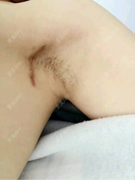 更美 - 万婷婷的假体隆胸经验 | 美购日记 | 专利隆胸 | 美基元 | 假体隆胸 | 武汉