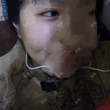 酒窝成形
