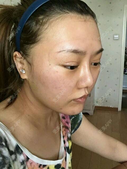 更美 - corinna的吸脂瘦大腿经验 | 大腿吸脂第一周 | 吸脂瘦大腿 | 美购日记 | 重庆
