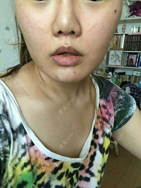 更美 - corinna的吸脂瘦大腿经验 | 大腿吸脂第一周 | 吸脂瘦大腿 | 美购日记 | 重庆