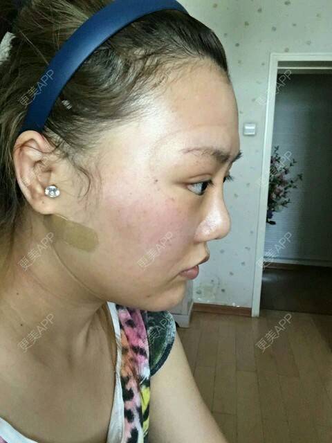 更美 - corinna的吸脂瘦大腿经验 | 大腿吸脂第一周 | 吸脂瘦大腿 | 美购日记 | 重庆