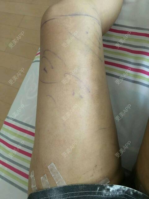 更美 - corinna的吸脂瘦大腿经验 | 大腿吸脂第一周 | 吸脂瘦大腿 | 美购日记 | 重庆